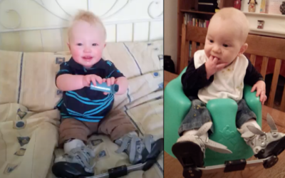 George and Henry’s clubfoot/talipes story