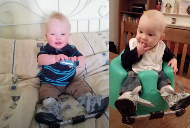 George and Henry’s clubfoot/talipes story