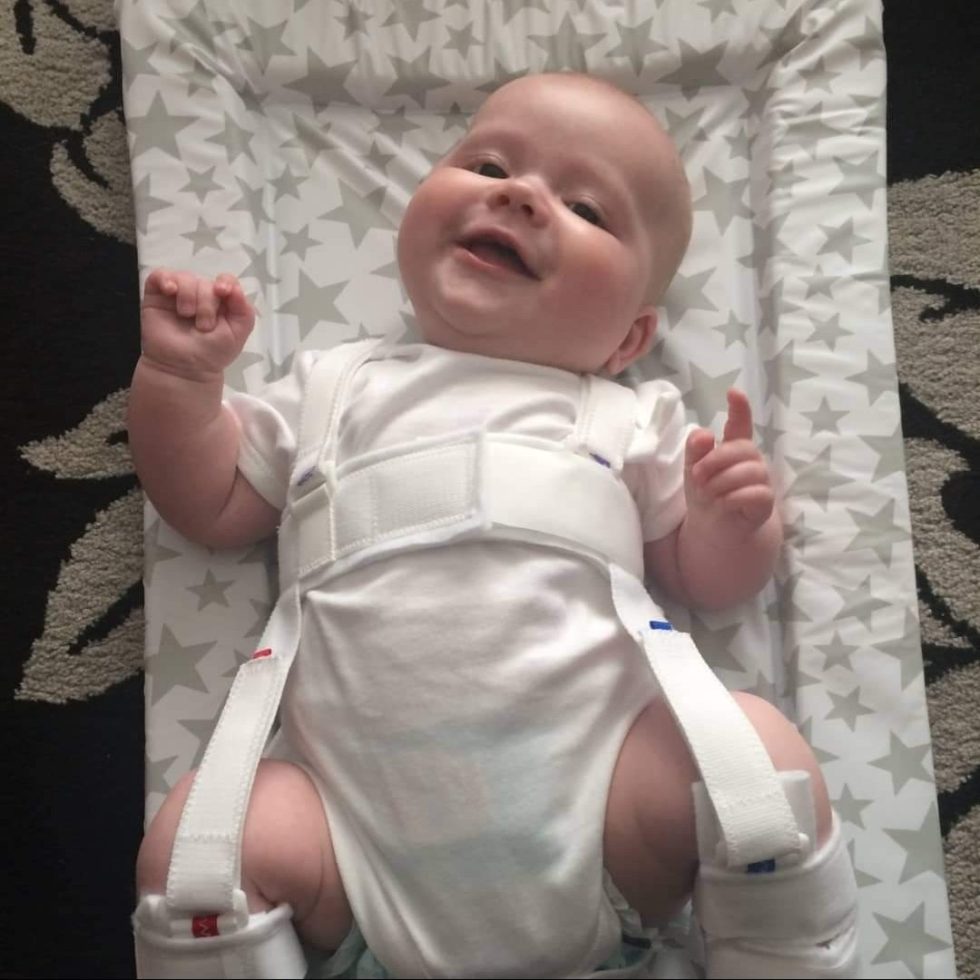 Lucy's story developmental dysplasia of the hip Pavlik harness STEPS
