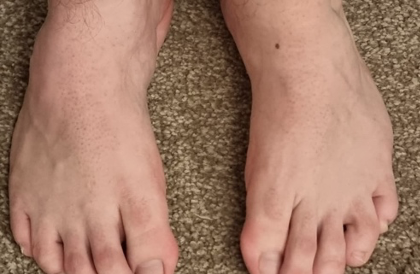 Adult feet with clubfoot