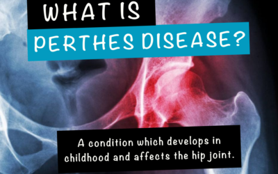 Understanding a painful, little-known condition in children: Perthes disease